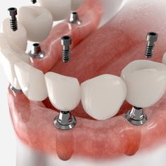 Dental Implants in Dumfries