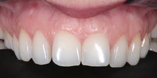 Transform Your Smile with Manchester Composite Bonding