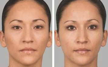 What Sets Sculptra Injections Apart At Personal Touch Aesthetic