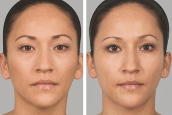What Sets Sculptra Injections Apart At Personal Touch Aesthetic