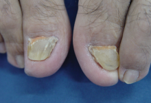 When Should You Consider a Matrixectomy for Toenail Issues