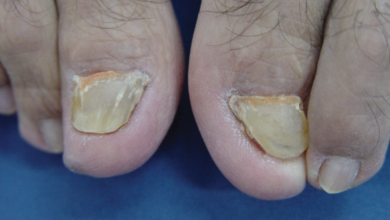 When Should You Consider a Matrixectomy for Toenail Issues