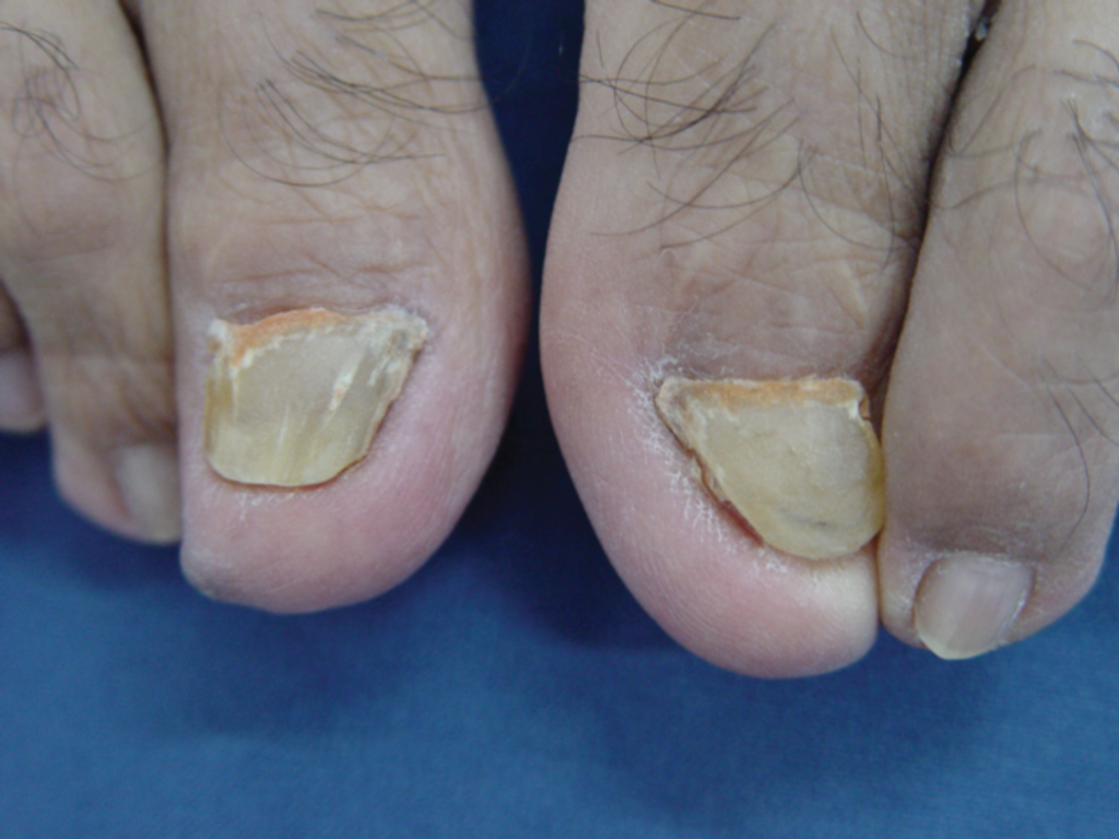 When Should You Consider a Matrixectomy for Toenail Issues