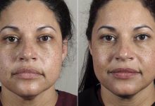 Laser Skin Tightening in New Jersey: Laser Treatment using Erbium YAG: Its Advantages