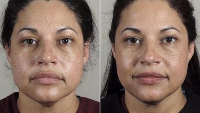 Laser Skin Tightening in New Jersey: Laser Treatment using Erbium YAG: Its Advantages