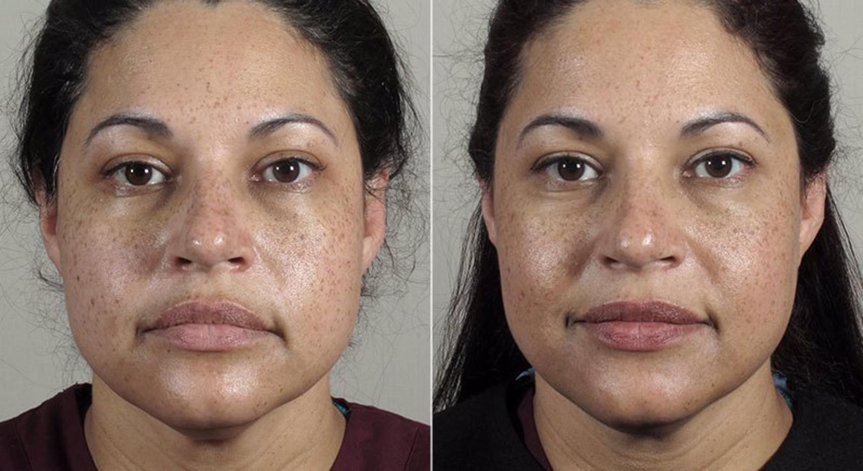 Laser Skin Tightening in New Jersey: Laser Treatment using Erbium YAG: Its Advantages